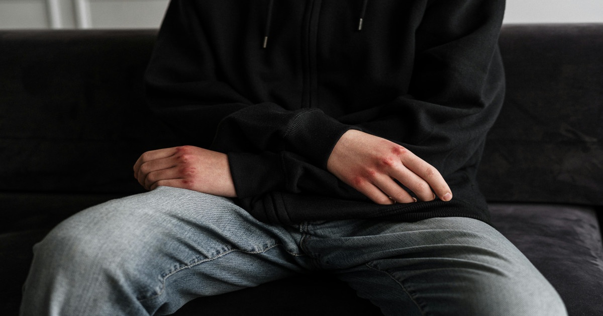 A man sitting on the couch with bruised knuckles.