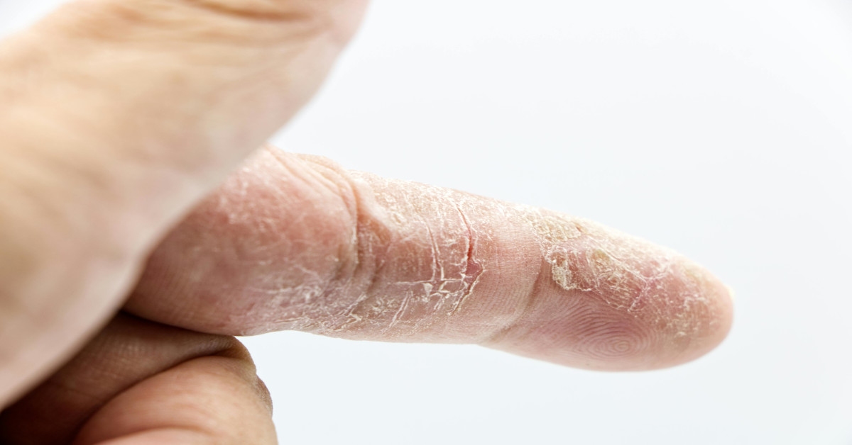 Image of someone's finger that has dry skin.